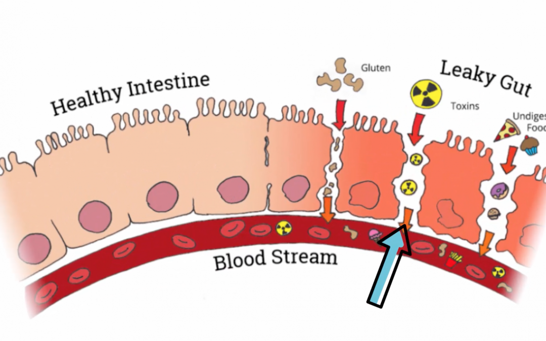 Gut Directed Hypnotherapy For IBS