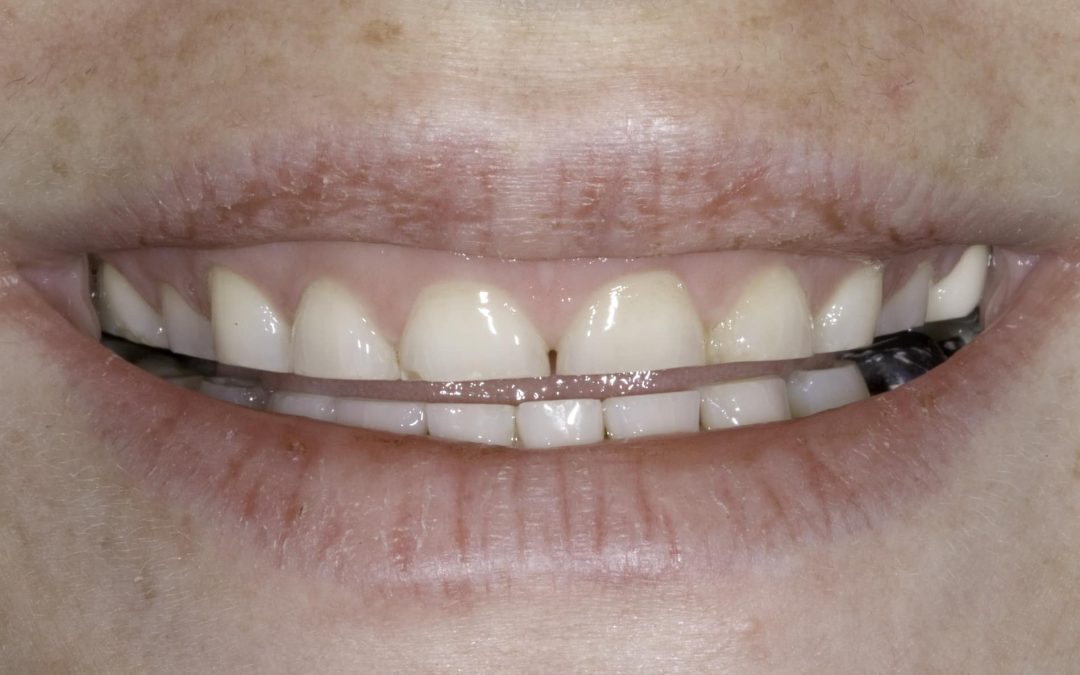 Teeth Grinding and Hypnosis